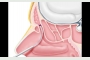 Relieva Sinus Spacer is placed in the newly opened frontal sinus.